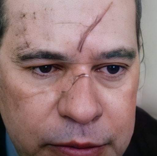 Dias Toffoli surge com hematomas no rosto em sessão do STF