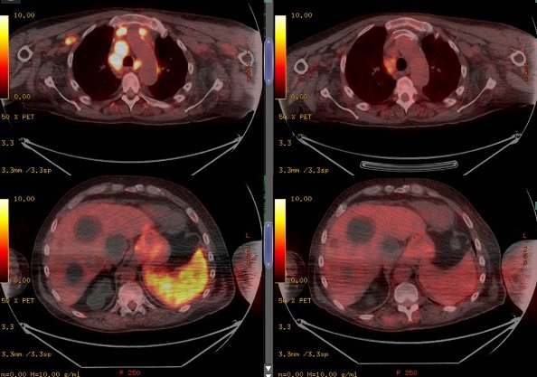 Entenda o caso do homem que teve regressão de câncer após contrair Covid-19
