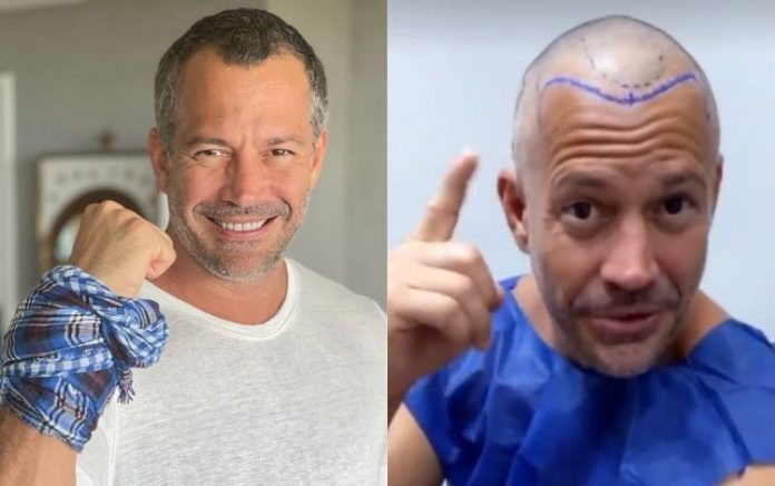 Malvino Salvador inicia transplante capilar para diminuir calvície