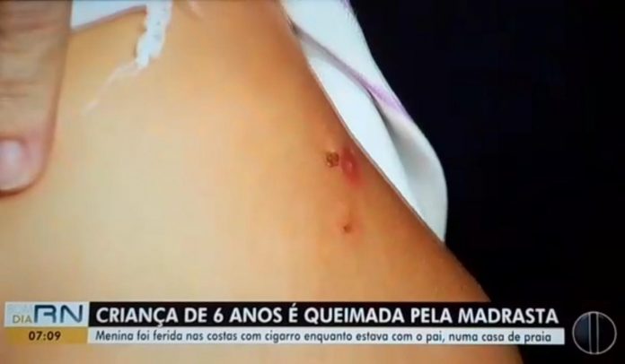 Madrasta é suspeita de queimar enteada de 6 anos com cigarro na Grande Natal; Polícia Civil investiga caso