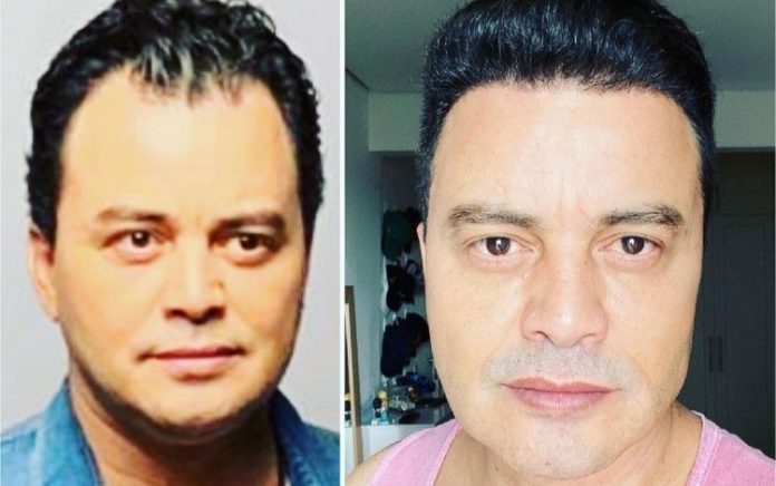 Cantor Renner impressiona ao mostrar antes e depois de procedimentos estéticos