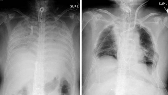 Japão faz 1º transplante de pulmão de doador vivo para paciente com Covid-19