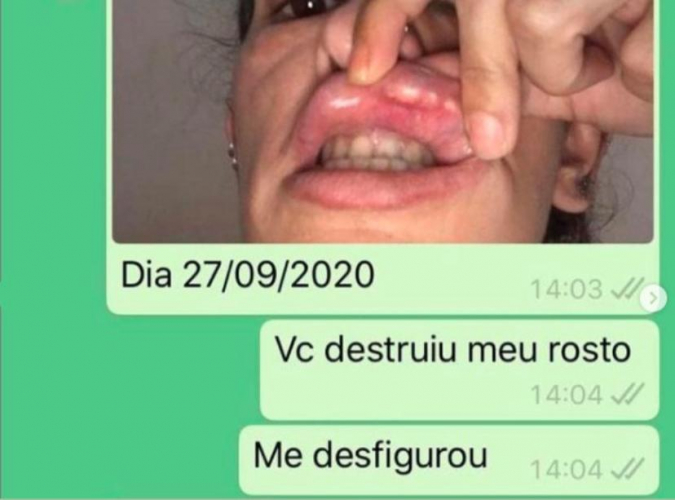 ‘Fui ao consultório aperfeiçoar minha beleza e virei um monstro’, diz paciente enganada por dentista