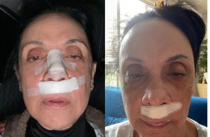 Cininha de Paula surge machucada e diz que caiu de cara no chão: ‘Uma queda e tanto’