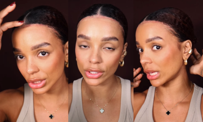 Brunna Gonçalves mostra resultado de cirurgia na testa: ‘Me sinto muito mais livre e segura’